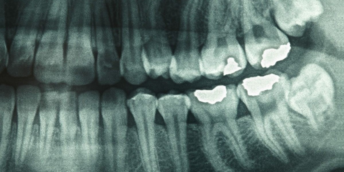 How Panoramic Dental X-Ray Cost Is Calculated