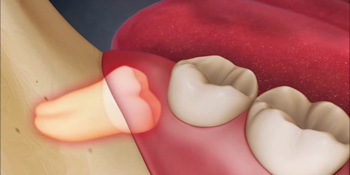Quy trình nhổ răng khôn: Chi tiết các bước, thời gian và lưu ý quan trọng
