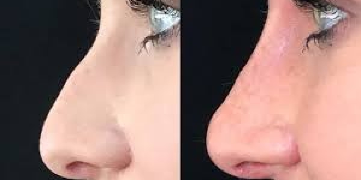 Enhance Your Features with Nonsurgical Rhinoplasty in Islamabad