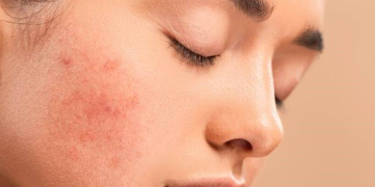Are there non-invasive options for pigmentation treatment?