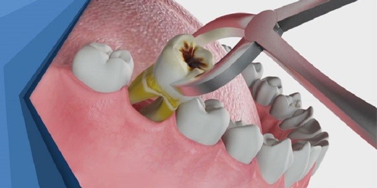 Sau khi nhổ răng khôn nên làm gì? Hướng dẫn chăm sóc chuẩn giúp mau lành và không đau