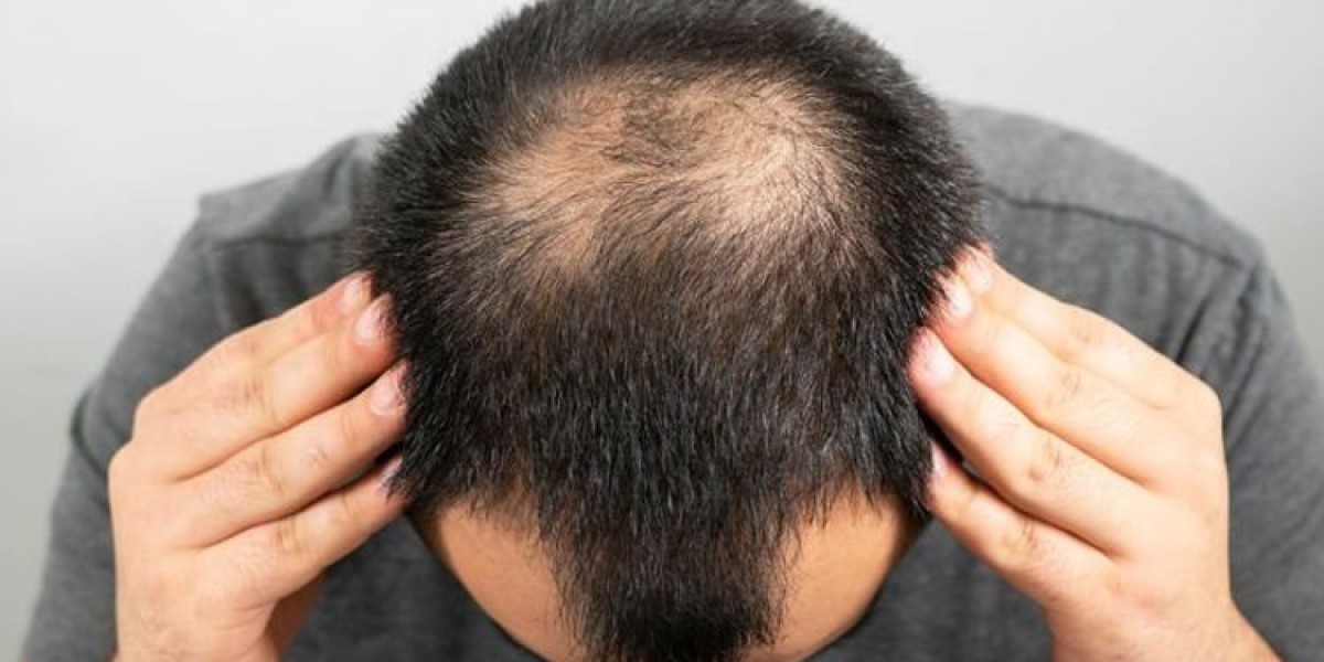 Is Hair Transplant in Dubai Permanent? Understanding Long-Term Results