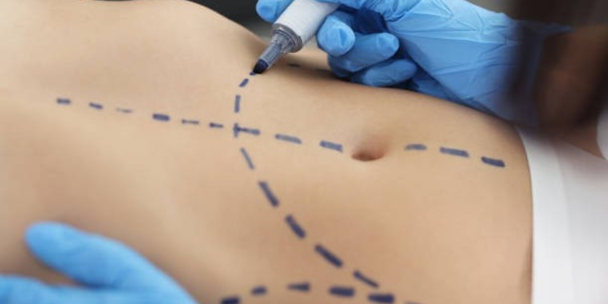 How to Choose Between Tumescent and Laser Liposuction in Riyadh