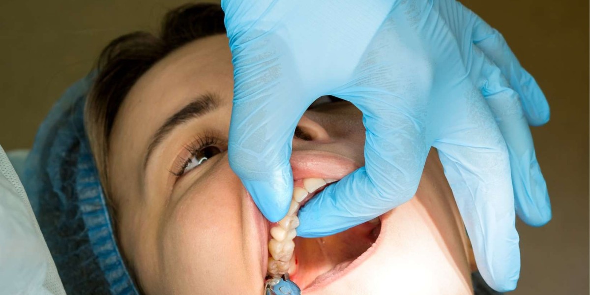 Impacted Tooth Removal: Causes, Process, and Recovery