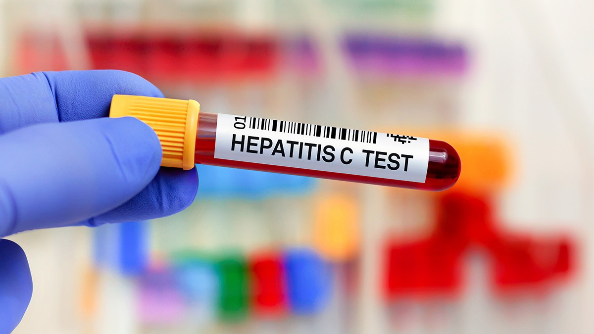 Hepatitis C Test in Dubai