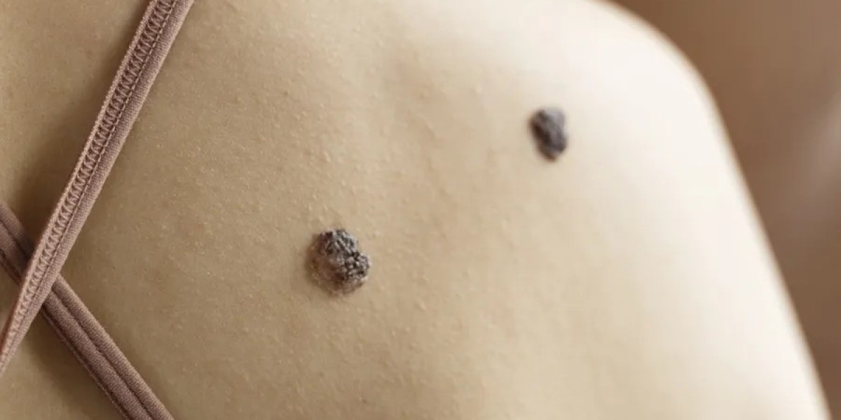 Can Birthmark Removal Improve Confidence?
