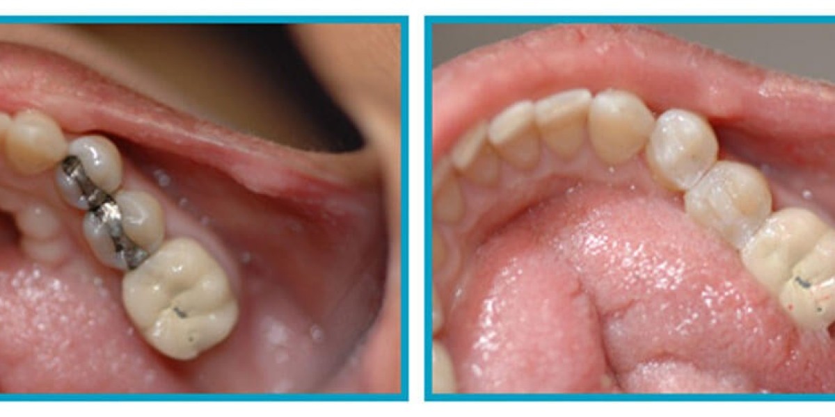 Why should you consider Dental filling in Islamabad for long-term oral health?