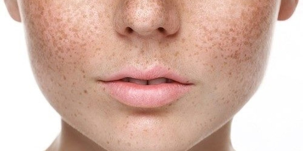 A Complete Guide to Pigmentation Treatment for Clearer Skin
