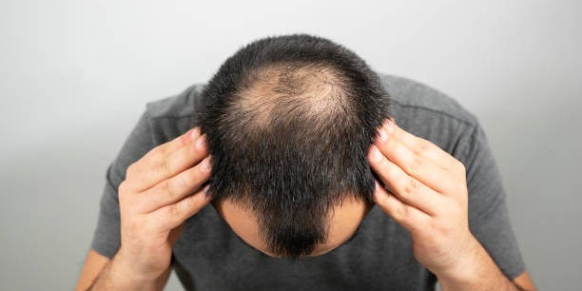 قصص نجاح زراعة الشعر في الرياض 2025