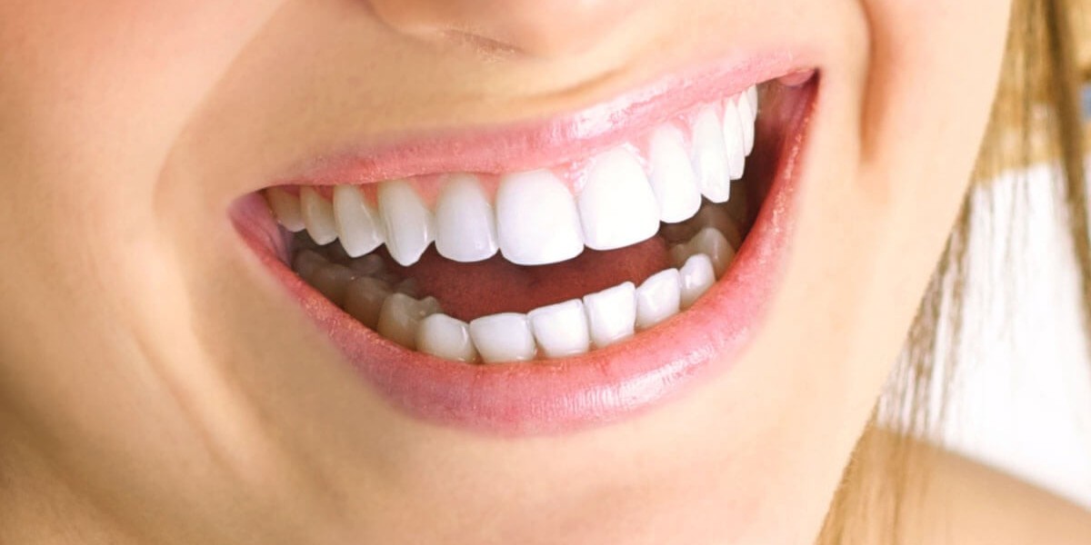 How Long Do E-Max Veneers Last? Durability and Care Tips