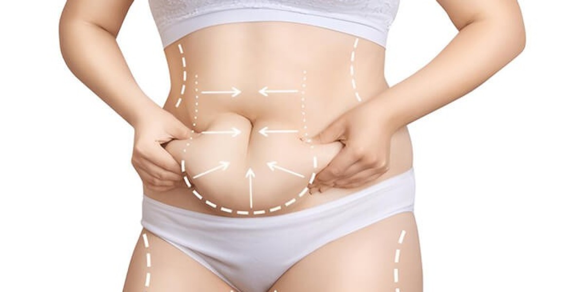How Is a Tummy Tuck Procedure Performed?