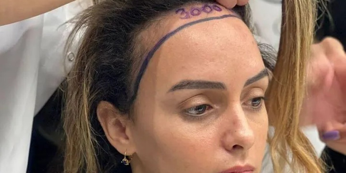 How Many Sessions of FUT Hair Transplant Are Needed?