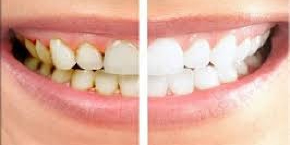 Tooth Crown Dubai Restoring Function and Aesthetics