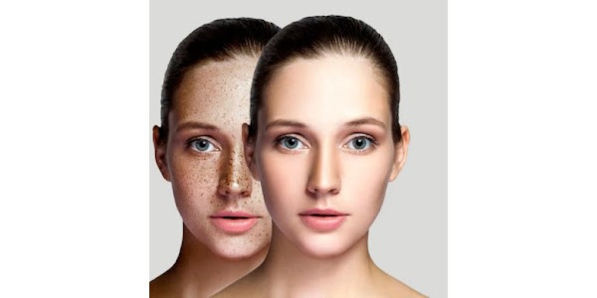 Evon Aesthetic Center: Melasma Treatment in Islamabad