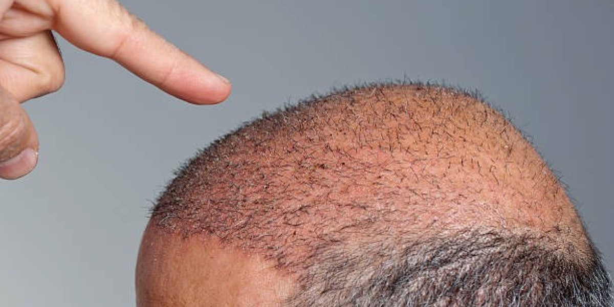 Hair Transplant Dubai: How to Avoid Scams and Fake Clinics
