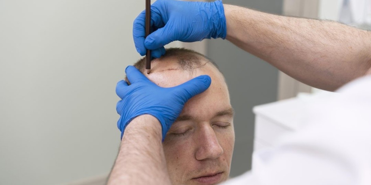 Do Hair Clinics Offer Alternatives To Surgical Hair Restoration?