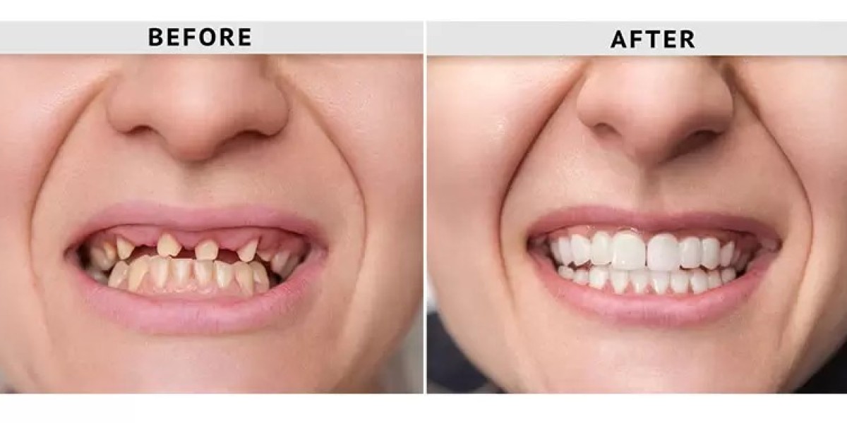 Restoring Smiles with Confidence