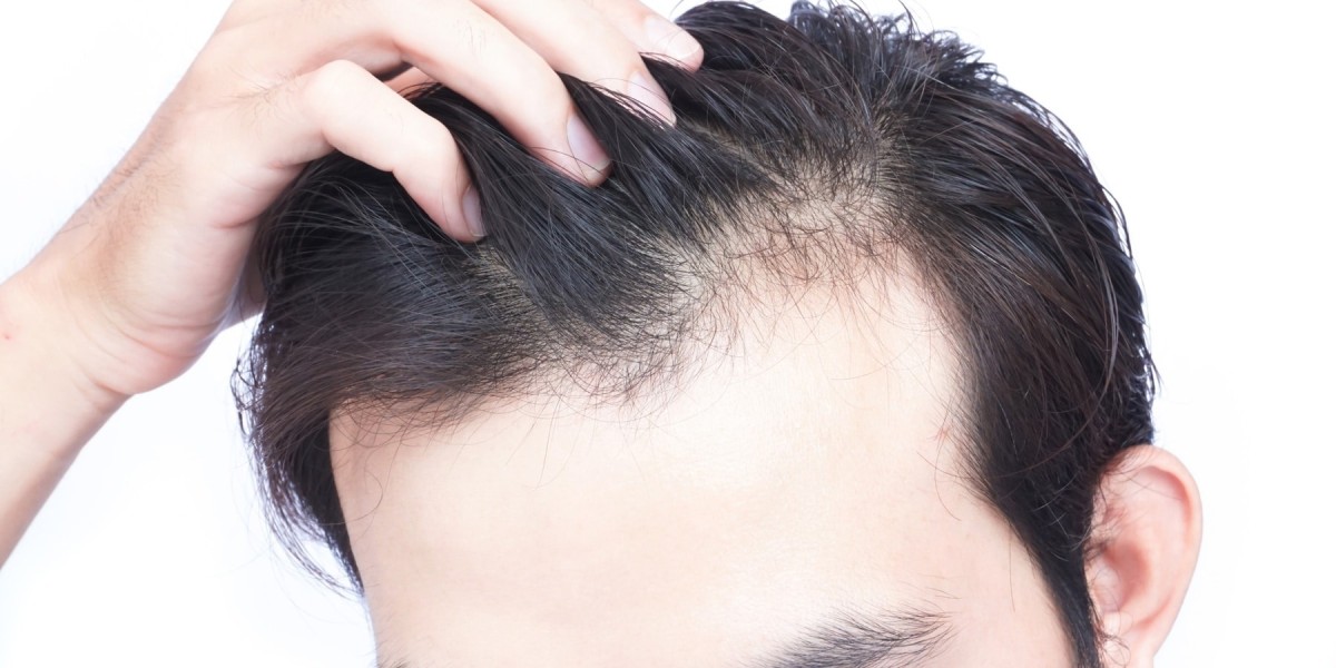 How Effective Is FUT Hair Transplant for Hair Loss?