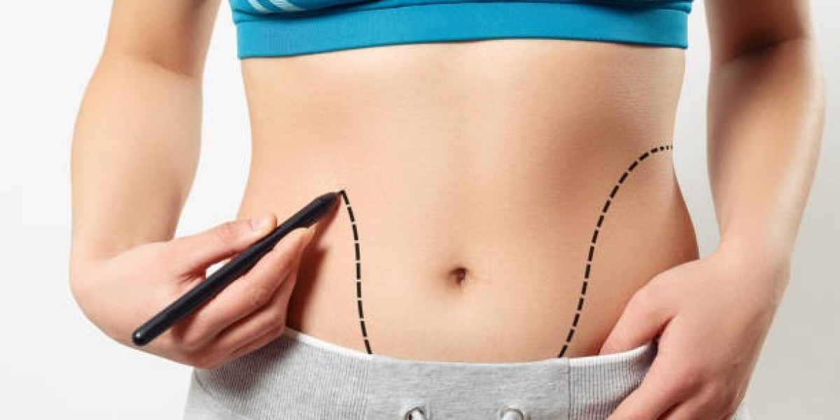 شفط الدهون بأحدث الأجهزة وتقنيات الأمان في الرياض للمظهر الرشيق