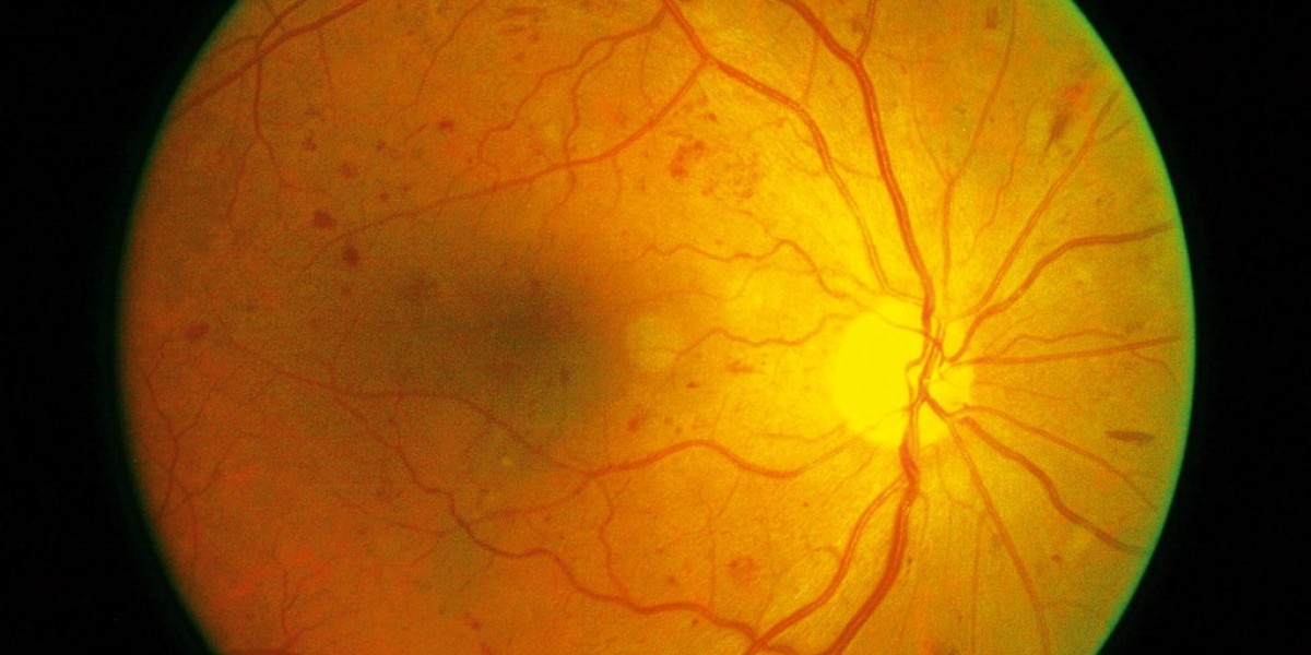 Proliferative Diabetic Retinopathy Market: Size, Trends, and Strategic Outlook 2025-2032