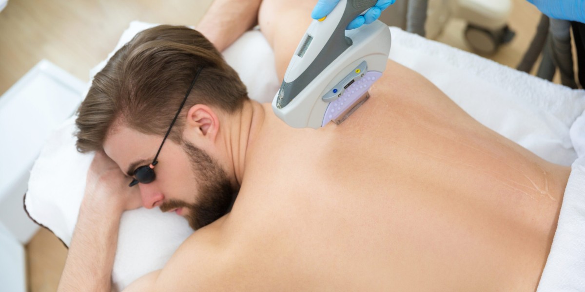 Can Laser Hair Removal Be Done on Men’s Back Hair?