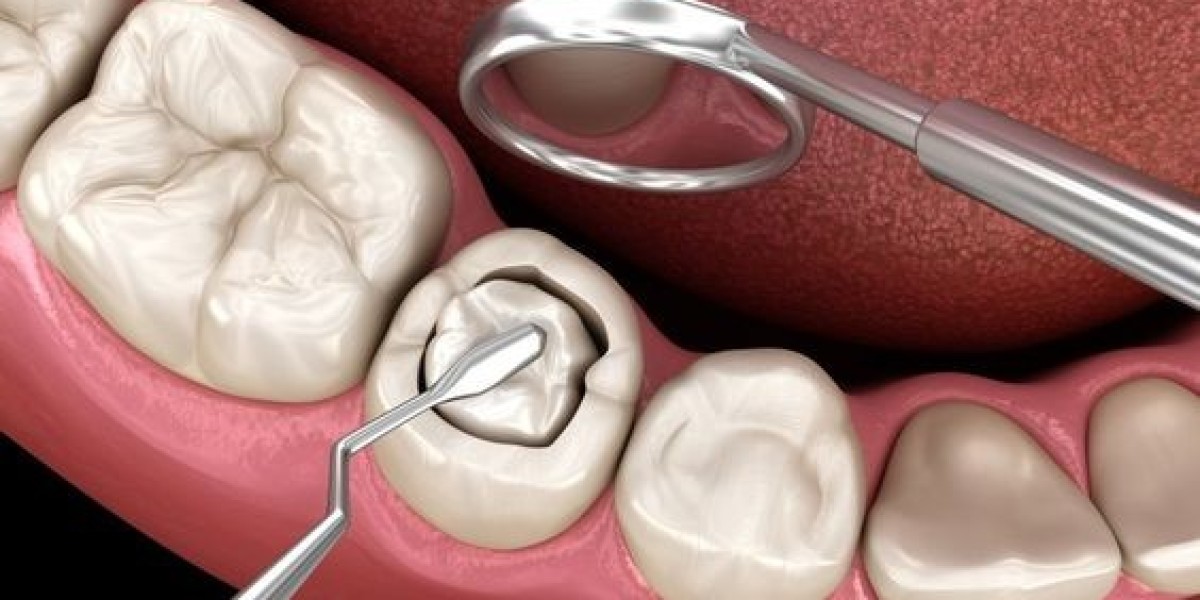 Quy trình trám răng chuẩn nha khoa: Hiểu đúng để không gặp biến chứng