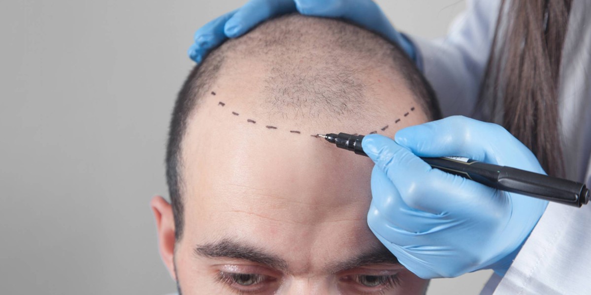 Hair Transplant Dubai Reinvents and Elevates Your Signature Style