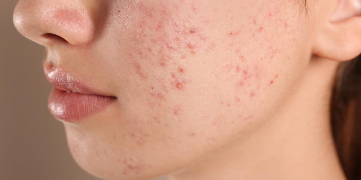 Why Acne Treatment Causes Breakouts First?