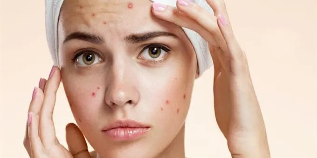 What’s the cost of acne treatments in Riyadh?
