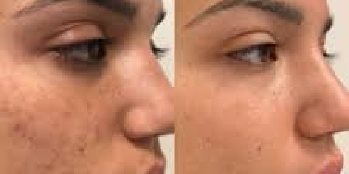 Microneedling Treatment in Islamabad – The Modern Path to Radiant Skin
