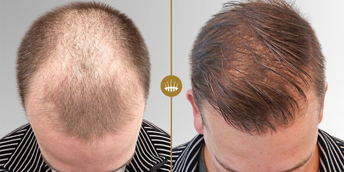 Dr. Naveed Hair Transplant – Truth About Guaranteed Results