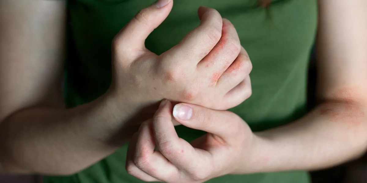Can a dermatologist treat scalp eczema and dandruff