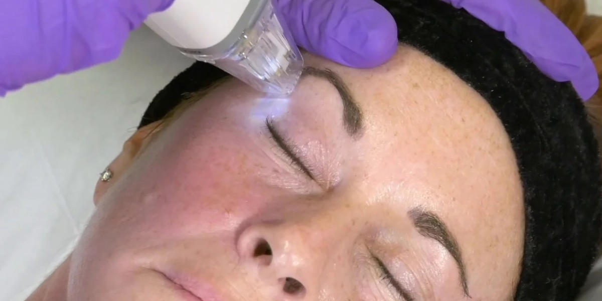Get Radiant Skin Tone with Fractional RF Microneedling