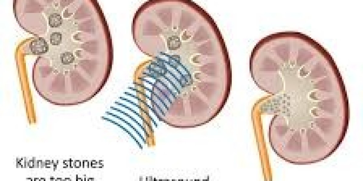 Kidney Stones Treatment: Finding the Right Kidney Stone Specialist