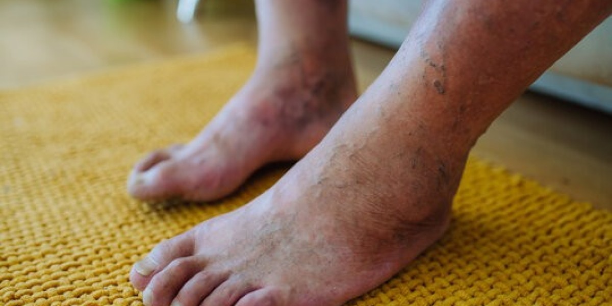 Diabetic Peripheral Neuropathy Market Size, Trends, and Growth Strategies 2025-2032