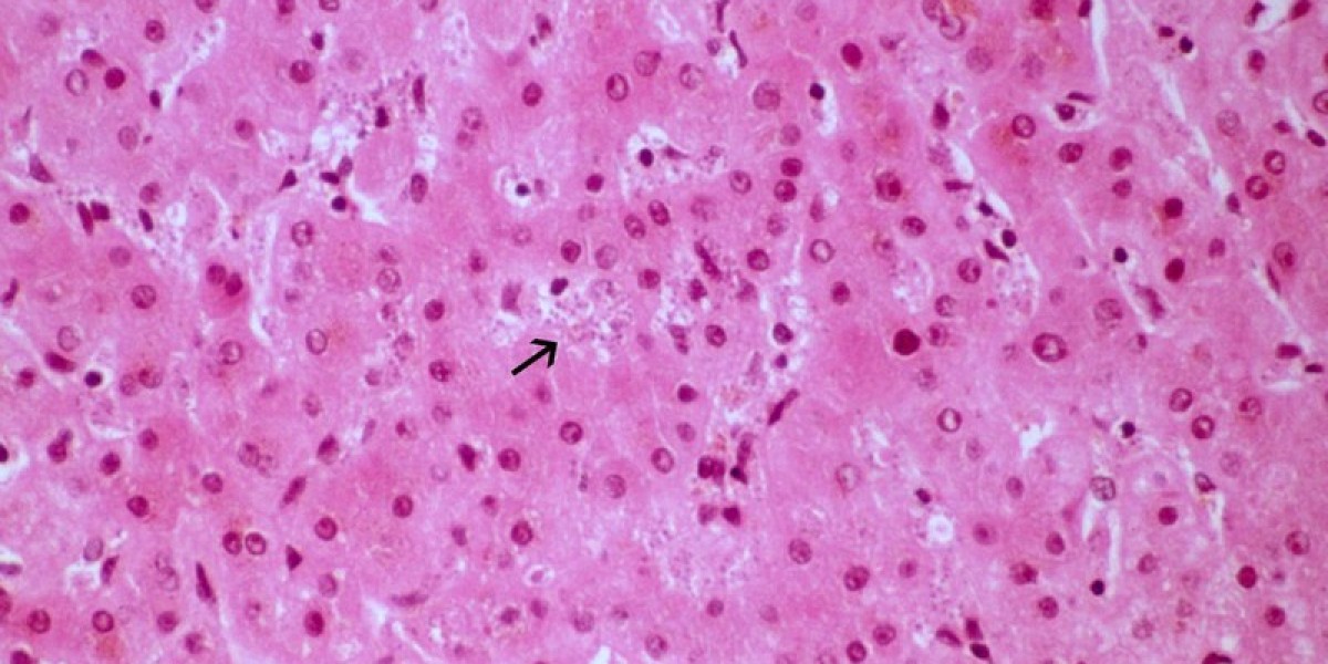 Visceral Leishmaniasis Market Trends: South Asia and Latin America Lead Growth