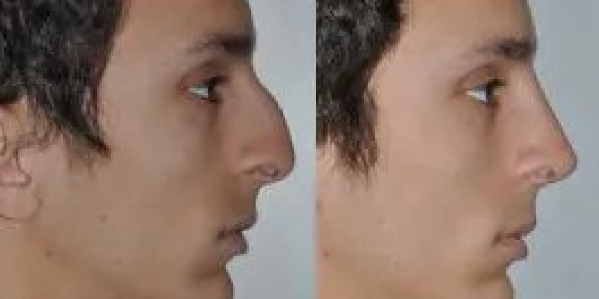 Liquid Rhinoplasty in Islamabad: A Modern Alternative to Nose Surgery