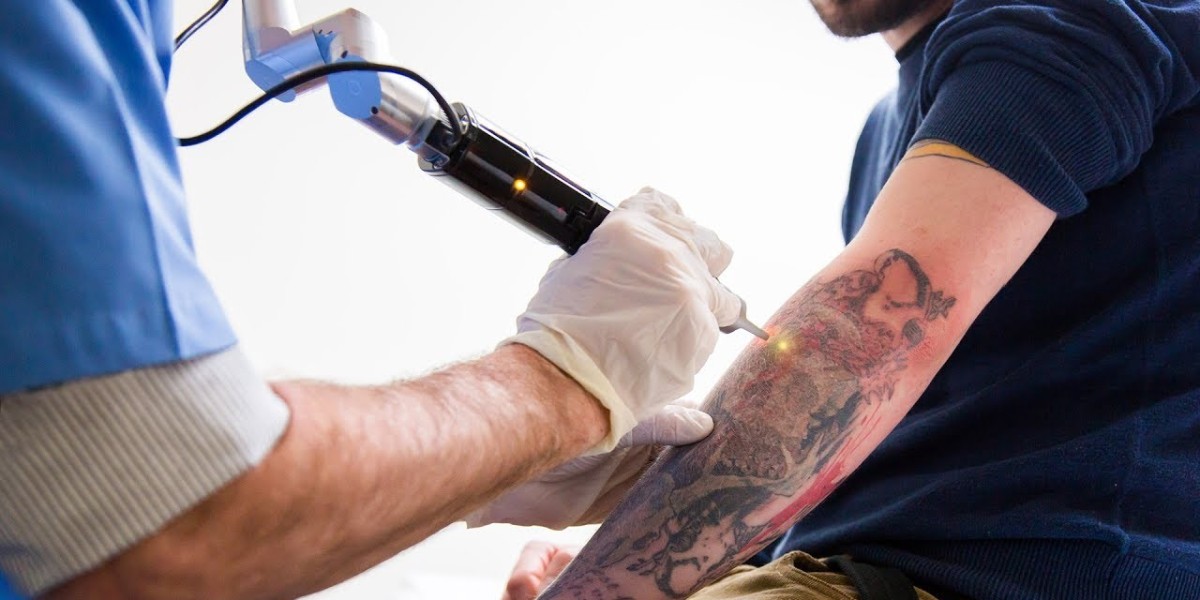 Seasonal Considerations: Best Time of Year for Tattoo Removal in Islamabad