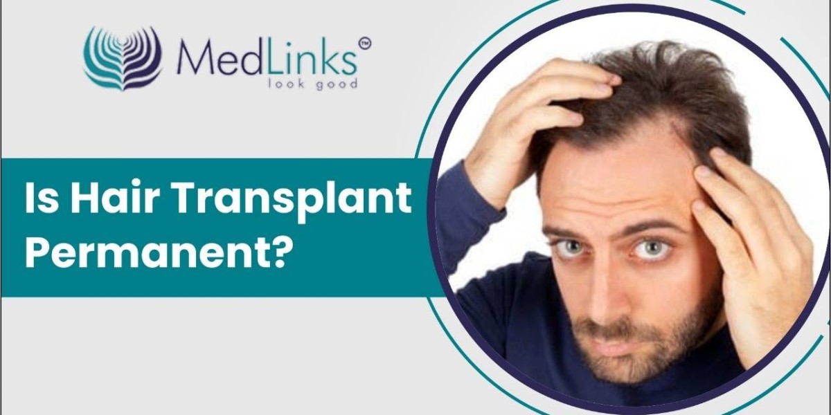 Is Hair Transplant Permanent? They Last Forever? | Hair Transplant in Delhi