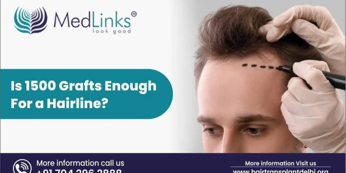 Is 1500 Grafts Enough for a Hairline? | Hair Transplant in Delhi