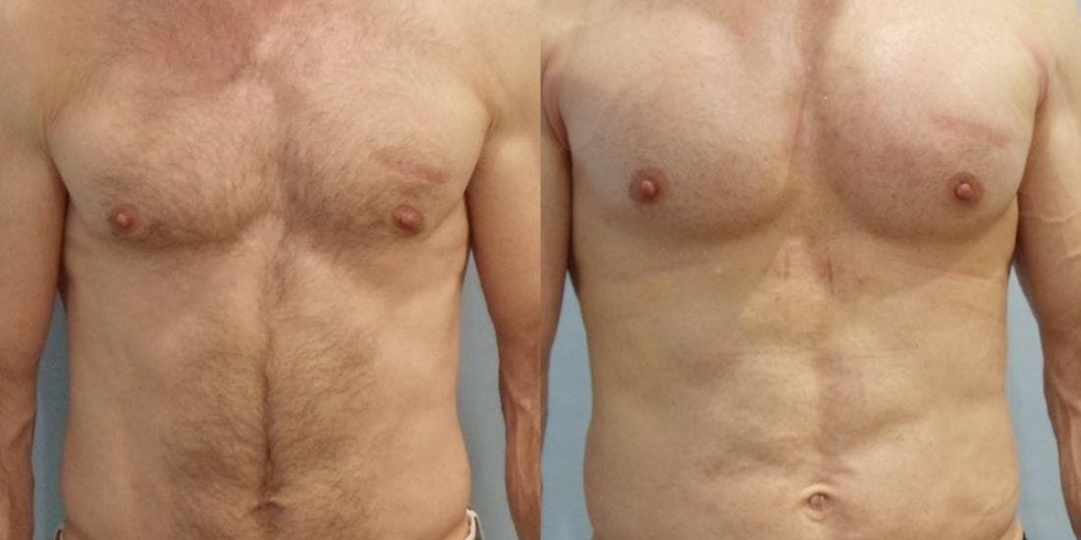 Gynecomastia Surgery’s Role in Male Body Image Enhancement