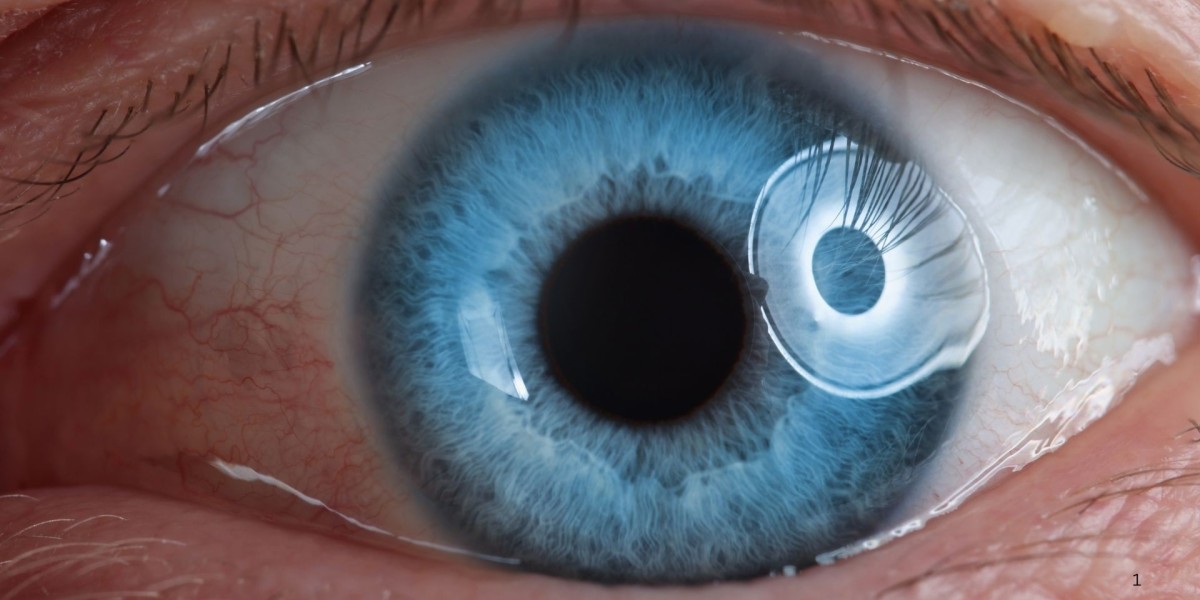 Retinal Surgery Devices Market Poised to Reach USD 4.84 Billion by 2033 – Renub Research