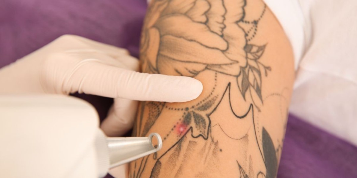 What to Expect from Best Picosure Tattoo Removal?