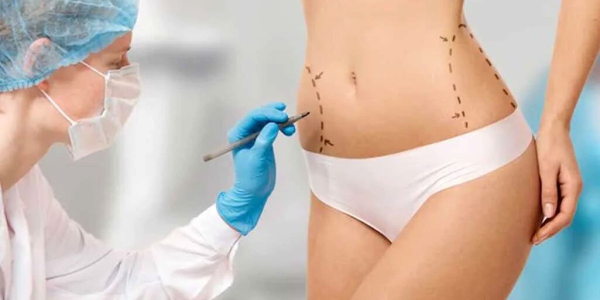 Why Doctors Recommend Liposuction in Islamabad for Back Fat