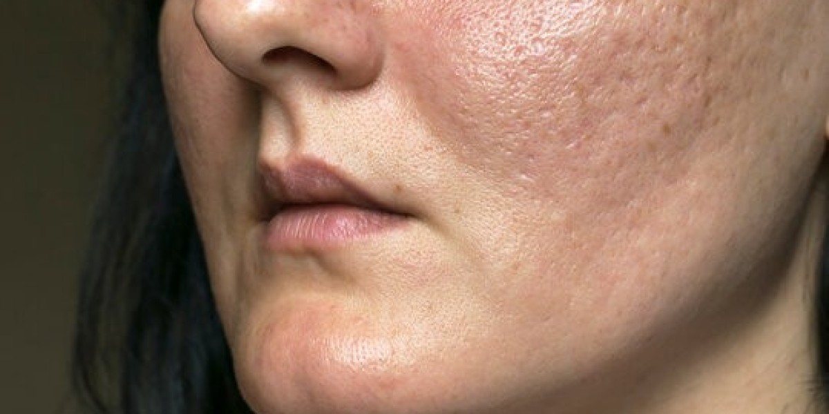 Trending Acne Scar Treatments in Islamabad This Year