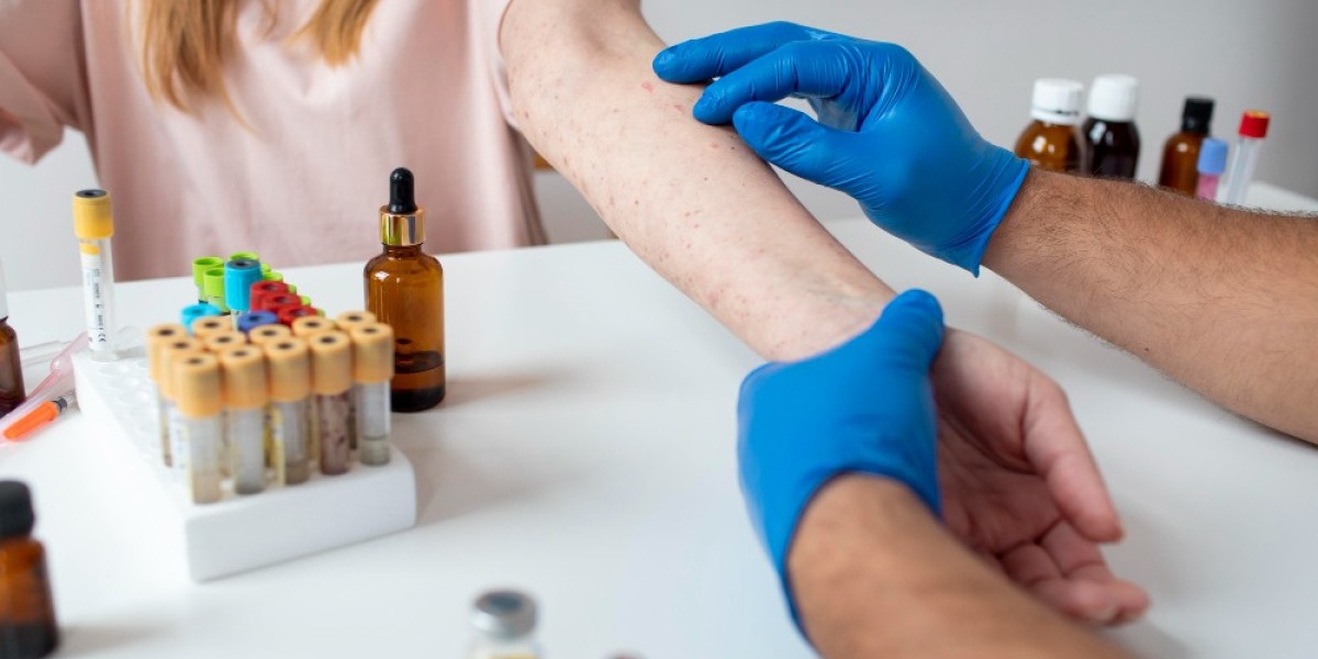 Understanding Spider Vein Treatment in Boerne, USA