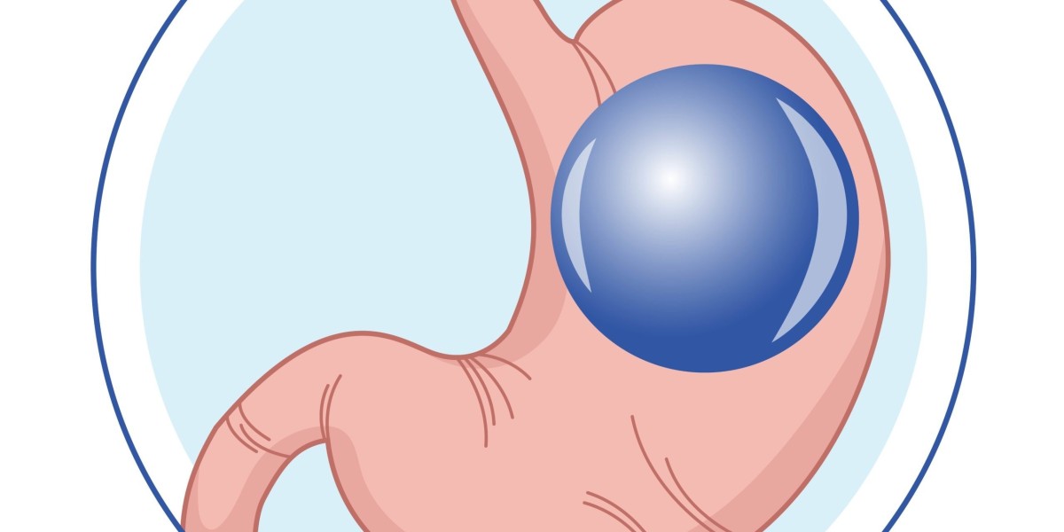 Gastric Balloon Placement Weight Loss Tips