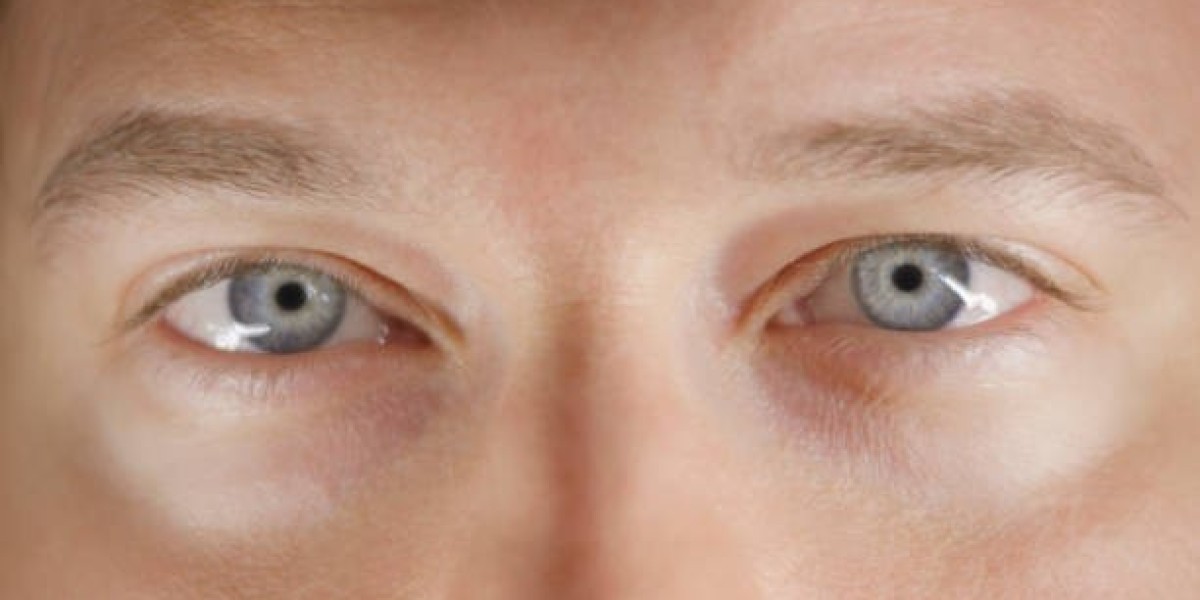 Eyelid Surgery Scars: How to Reduce Visibility Naturally