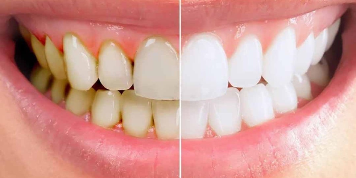 Bao lâu lấy cao răng 1 lần là lý tưởng để giữ hàm răng khỏe mạnh?