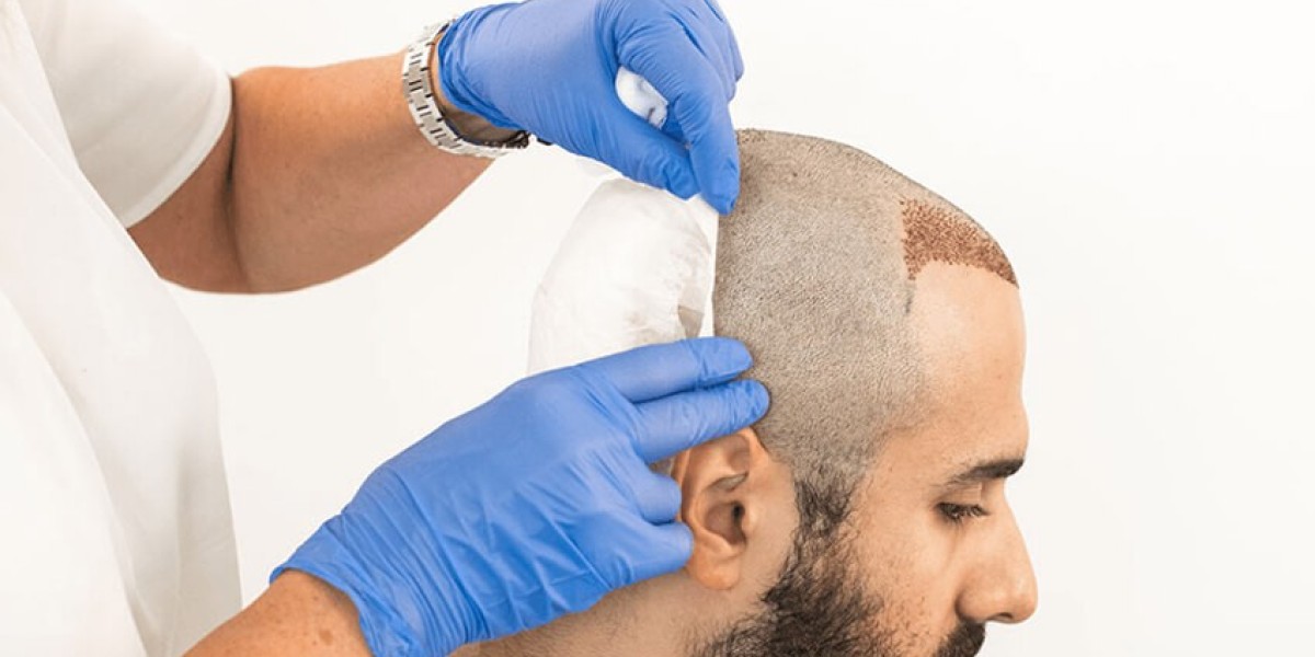 Hair Transplant Cost in Delhi: A Complete Breakdown